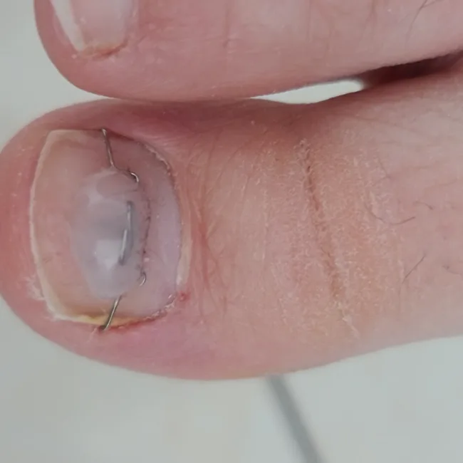 ingrown toenail - 1