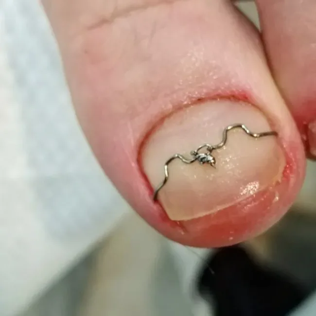 ingrown toenail - 2