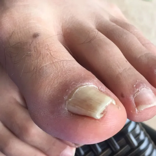 ingrown toenail - 3