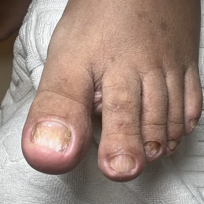 toenail fungus - 1