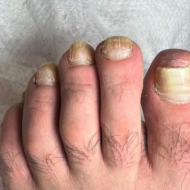 toenail fungus - 3